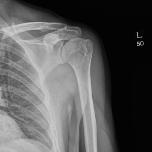 frozen shoulder