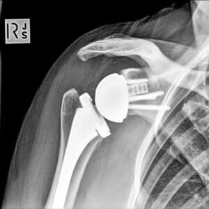 total shoulder replacement